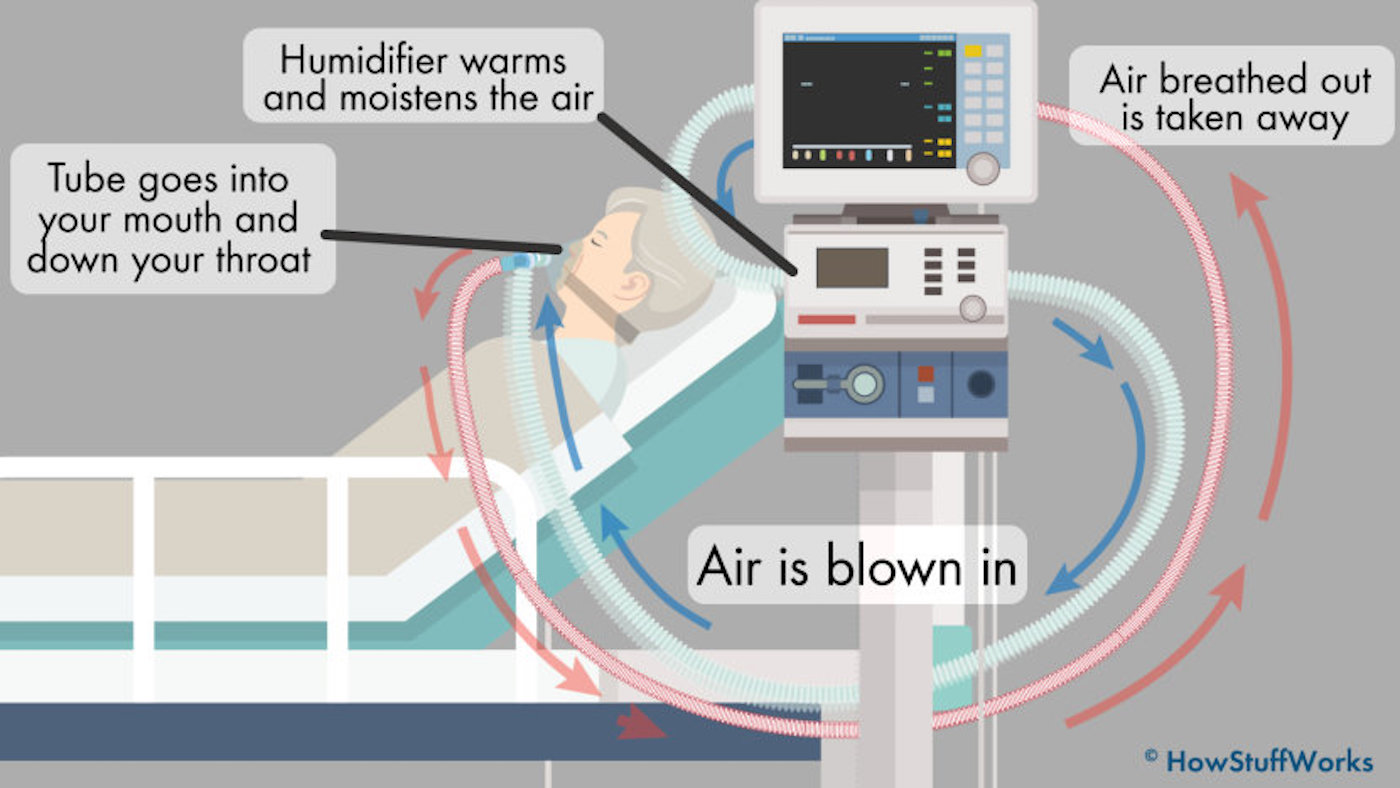 Newsela How do ventilators work?